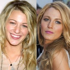 Blake Lively avant-après la chirurgie esthétique : les photos choc de sa transformation physique