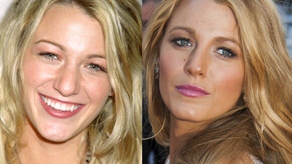 Blake Lively avant-après la chirurgie esthétique : les photos choc de sa transformation physique