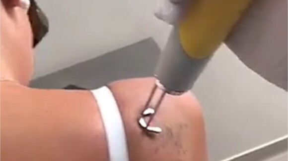 Amélie Neten se fait enlever deux tatouages sur Snapchat