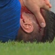 Olivier Giroud blessé et en sang pendant le match France/Etats-Unis : les images chocs