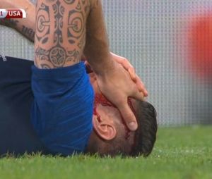 Olivier Giroud blessé et en sang pendant le match France/Etats-Unis : les images chocs