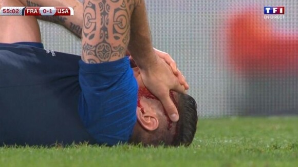 Olivier Giroud blessé et en sang pendant le match France/Etats-Unis : les images chocs