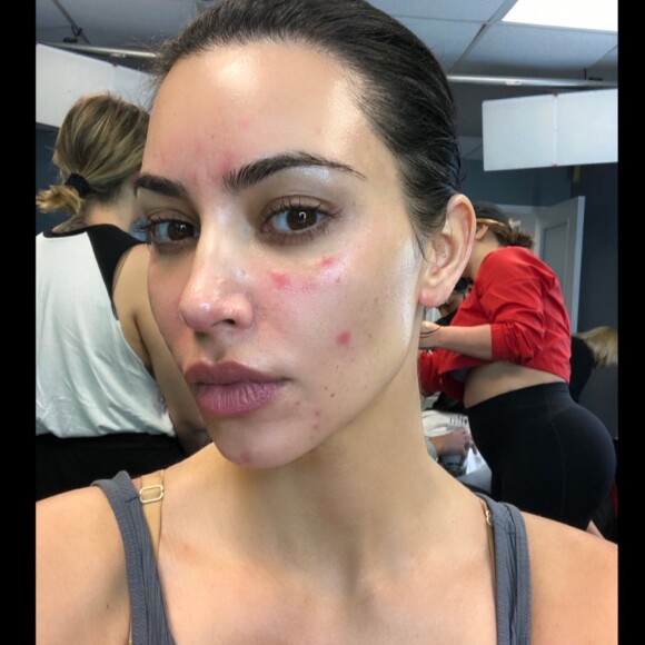 Kim Kardashian sans maquillage : elle assume ses boutons de psoriasis, les internautes valident