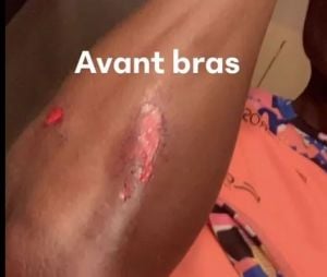 Koh Lanta, La Légende : Coumba blessée après une chute à vélo, les photos choquantes de ses blessures