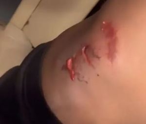 Koh Lanta, La Légende : Coumba blessée après une chute à vélo, les photos choquantes de ses blessures
