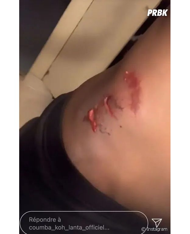 Koh Lanta, La Légende : Coumba blessée après une chute à vélo, les photos choquantes de ses blessures