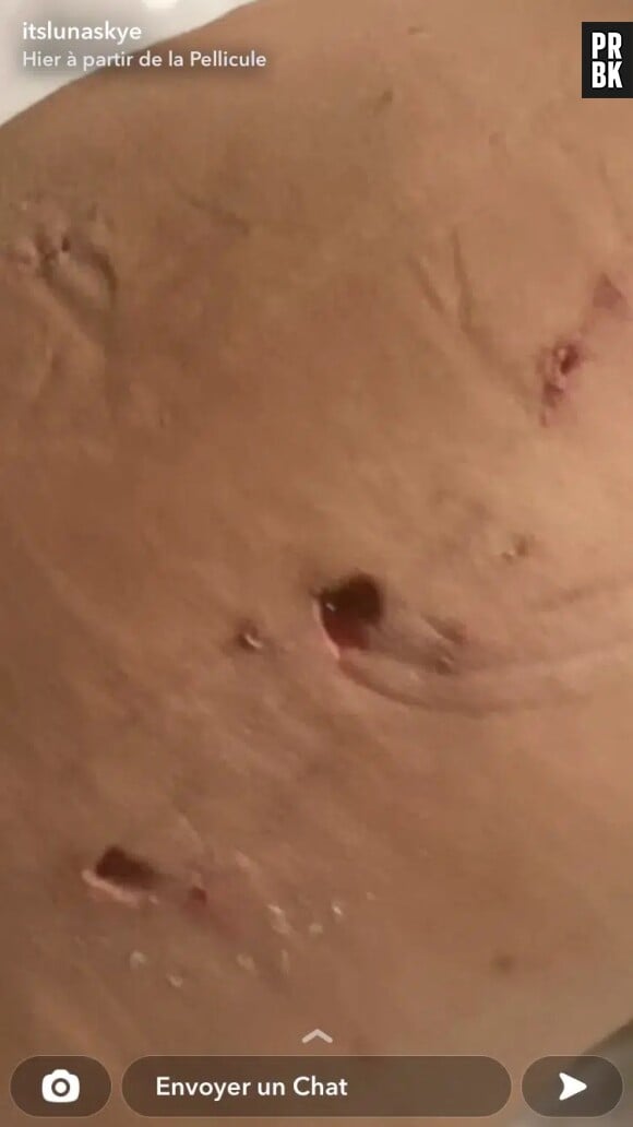 Luna Skye poste une photo choc de ses "trous" après ses opérations