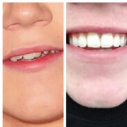 Niall Horan retrouve le sourire : bye bye son appareil dentaire