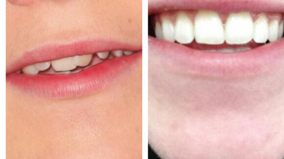 Niall Horan retrouve le sourire : bye bye son appareil dentaire