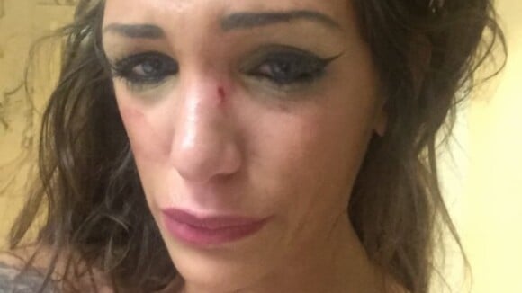 Julia (Les Anges 7) agressée à Cannes ? Les photos chocs de sa blessure au visage