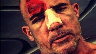 Dominic Purcell blessé sur le tournage de Prison Break : les photos sanglantes