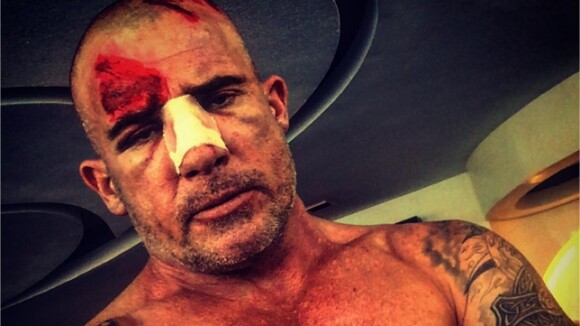 Dominic Purcell blessé sur le tournage de Prison Break : les photos sanglantes