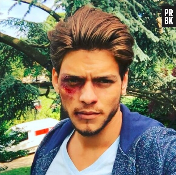 Rayane Bensetti blessé sur Instagram... pour le tournage de Clem