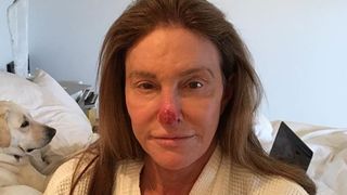 Caitlyn Jenner défigurée : elle plaisante sur son nez en sang suite à des cellules cancéreuses