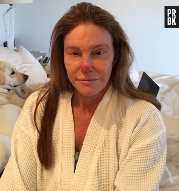 Caitlyn Jenner défigurée : le père de Kylie Jenner et de Kendall Jenner dévoile une photo choc avec le nez en sang !