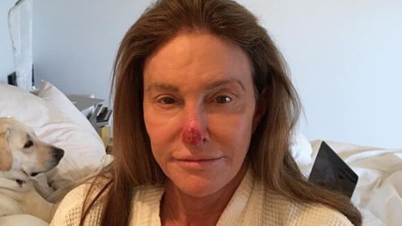 Caitlyn Jenner défigurée : elle plaisante sur son nez en sang suite à des cellules cancéreuses