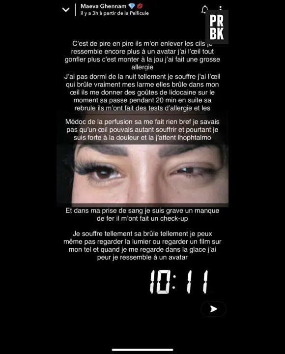 Maeva Ghennam défigurée et hospitalisée, dévoile une photo choc : la candidate des Marseillais au Mexique se confie sur son oeil qui la fait souffrir.