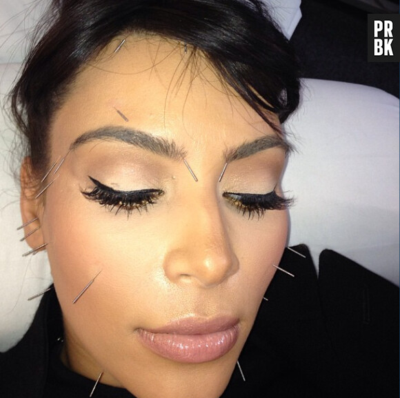 Kim Kardashian s'est fait une séance d'acuponcture