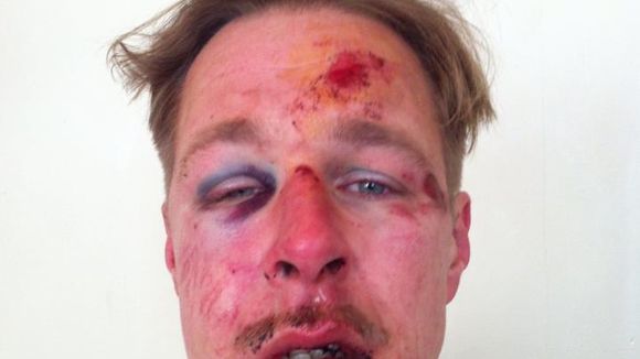 Homophobie : Wilfred, le visage en sang sur Facebook pour dénoncer les agressions