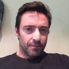 Hugh Jackman, atteint d'un cancer de la peau
