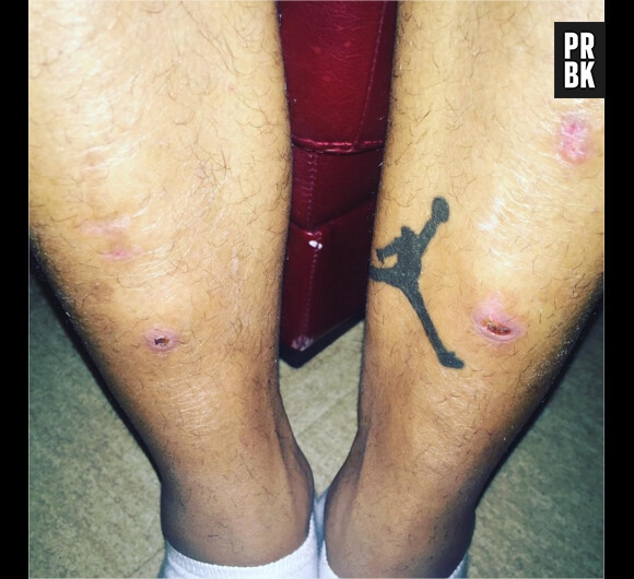 Nicolas (Secret Story 9) blessé pendant l'aventure : ses cicatrices dévoilées sur Instagram