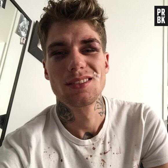 Victime d'une agression homophobe à Toulouse, Clément s'exprime sur Facebook et touche les internautes