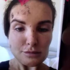 Marie Garet "défigurée" : en larmes, elle dévoile des photos choc de son accident