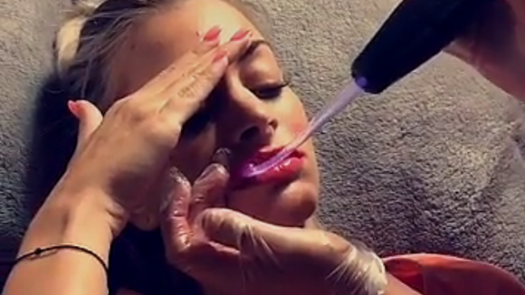 Mélanie Da Cruz s'offre ses nouvelles lèvres pulpeuses, comme Coralie Porrovecchio