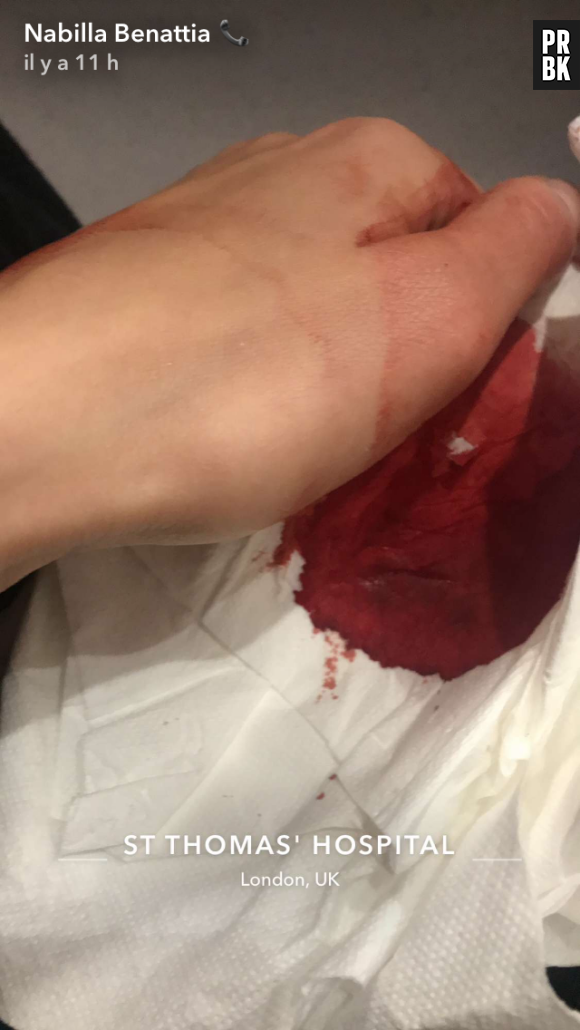 Nabilla Benattia à l'hôpital : elle dévoile sa blessure sur Snapchat
