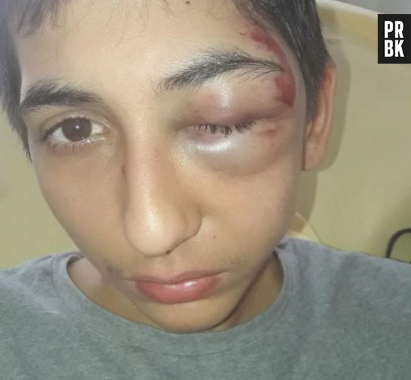 Violences policières : le témoignage choc de Gabriel, 14 ans, défiguré après une interpellation