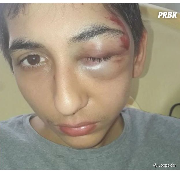 Violences policières : le témoignage choc de Gabriel, 14 ans, défiguré après une interpellation
