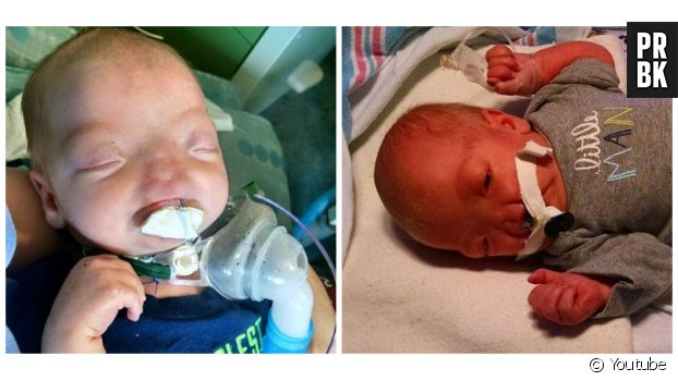 Eli est un bébé né en Alabama sans nez, ce qui ne l&#039;empêche pas de respirer par la bouche naturellement.