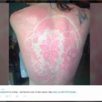 Les tatouages éphémères &quot;coup de soleil&quot; : la mode dangereuse de l&#039;été