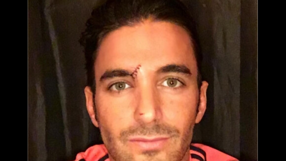 Thomas Vergara blessé : la photo sanglante sur Instagram