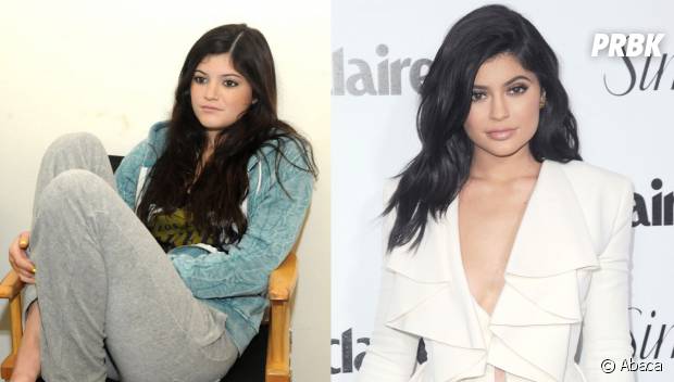 Kylie Jenner Transformée Son Chirurgien Esthétique Balance