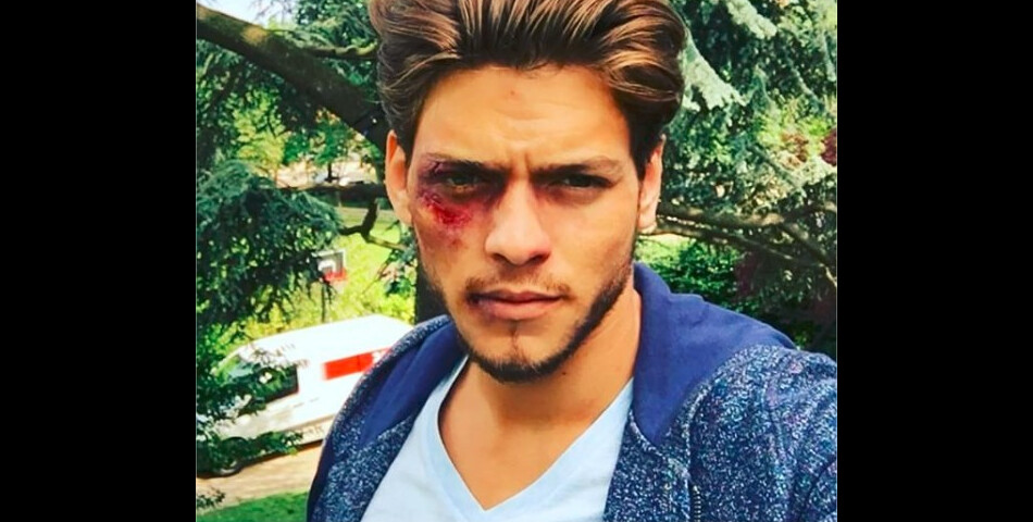 Rayane Bensetti blessé sur Instagram... pour le tournage de Clem