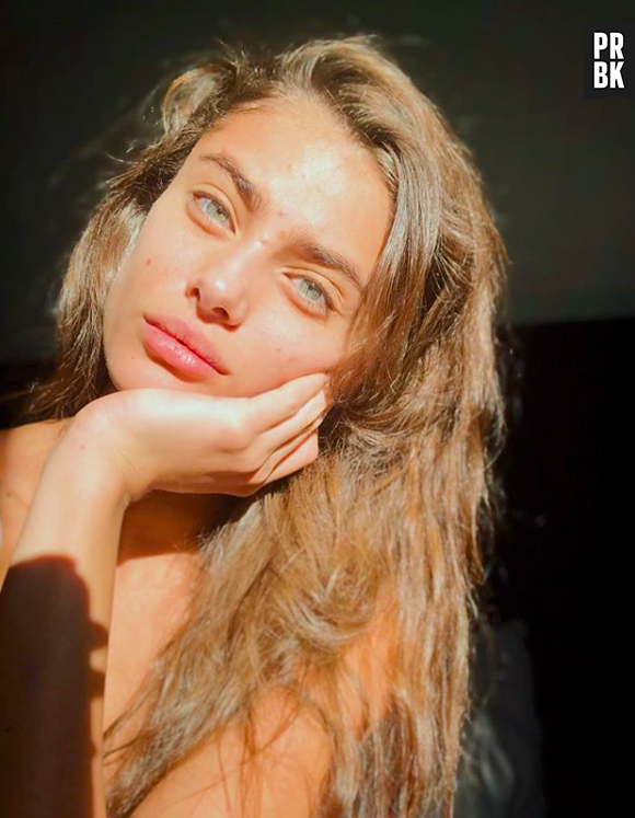 Taylor Hill : la top de Victoria's Secret assume ses boutons d'acné sur Instagram.