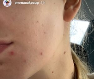 Emma CakeCup s'affiche sans maquillage : "ma peau, ça commence à devenir un complexe"