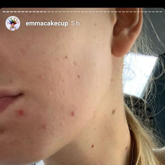 Emma CakeCup s'affiche sans maquillage : "ma peau, ça commence à devenir un complexe"