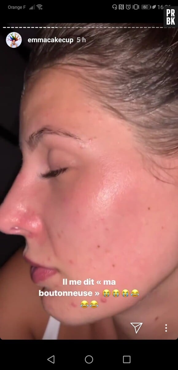 Emma CakeCup s'affiche sans maquillage : "ma peau, ça commence à devenir un complexe"