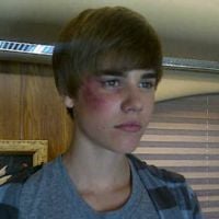 Justin Bieber ... Hospitalisé d’urgence