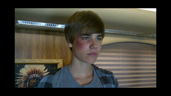 Justin Bieber ... Hospitalisé d’urgence
