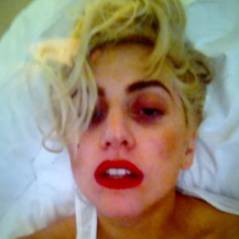 Lady Gaga et la barre de fer : elle affiche son bobo sur Twitter (PHOTO)