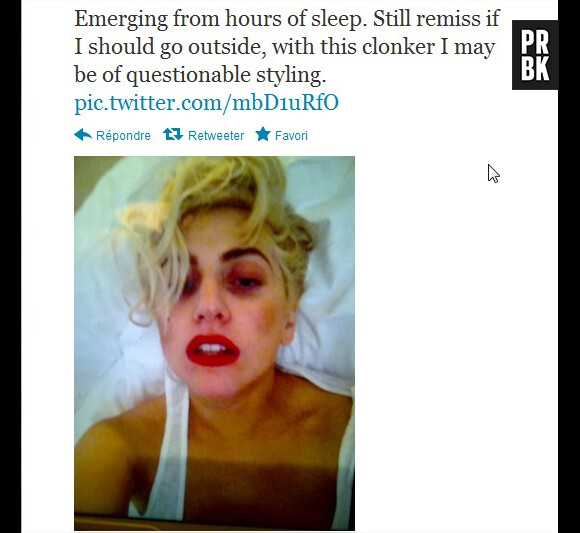 Lady Gaga est son fameux hématome
