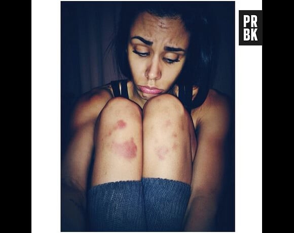 Shy'm : les jambes abîmées par la danse, le 28 février 2014 sur Instagram