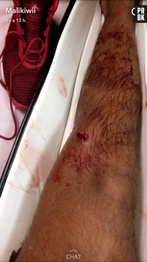 Sarah Fraisou : son ex Malik blessé par balle, les photos chocs sur Snapchat !