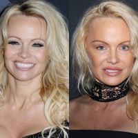 Pamela Anderson défigurée par la chirurgie ? La bombe d&#039;Alerte à Malibu est méconnaissable