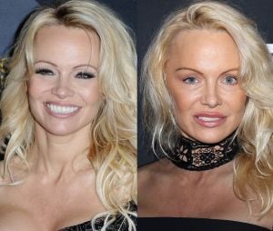 Pamela Anderson avant-après : à gauche il y a quelques semaines seulement et à droite le 7 janvier 2017. A-t-elle fait de la chirurgie à son visage ?