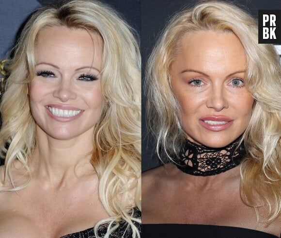 Pamela Anderson avant-après : à gauche il y a quelques semaines seulement et à droite le 7 janvier 2017. A-t-elle fait de la chirurgie à son visage ?