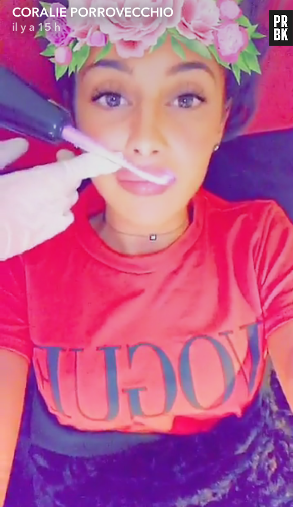 Coralie Porrovecchion montre son remodelage des lèvres sur Snapchat